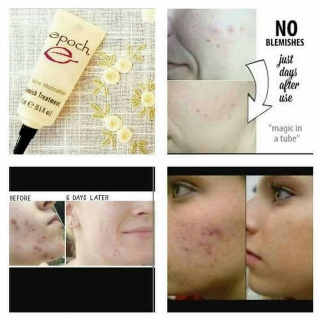 epoch-blemish-treatment-005